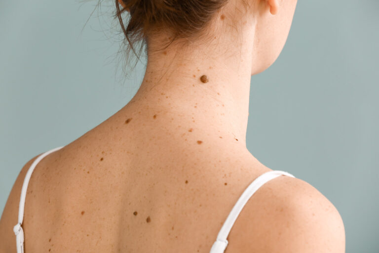 When to Worry About a Mole: Your Guide to Healthy Skin