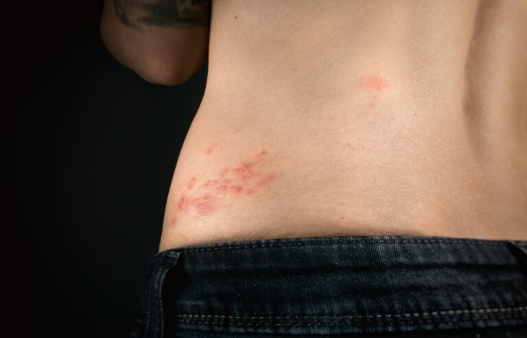 Shingles Exposed: Recognizing Symptoms, Exploring Treatments, and Preventing Outbreaks