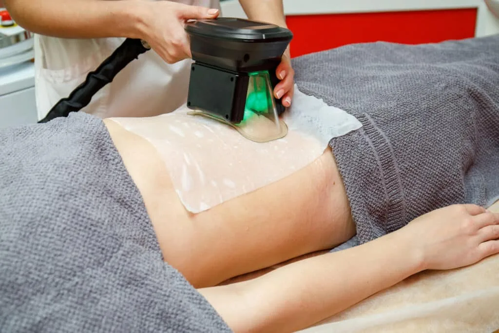 Coolsculpting 1024x683 1 1