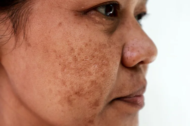 Dark Spots Be Gone: The Ultimate Guide to Fading Hyperpigmentation for Good